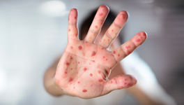 measles - palm of a had covered in measles
