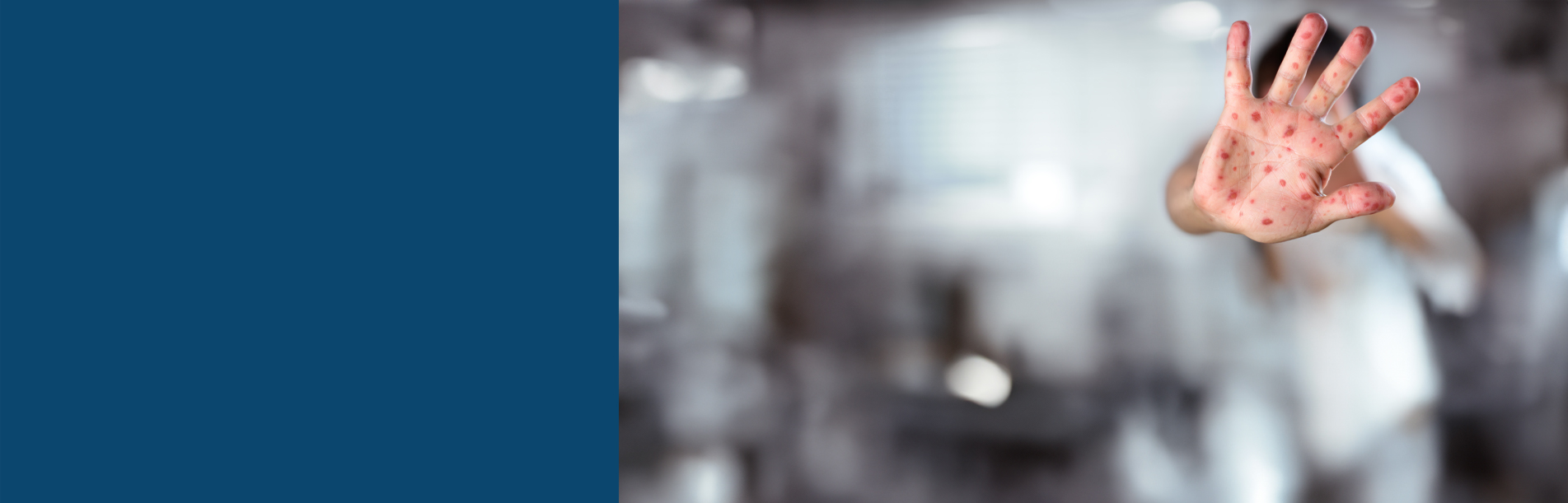 measles header - palm of hand covered in measles